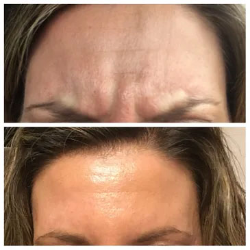 BOTULINUM TOXIN WRINKLE TREATMENT BOTULINUM TOXIN WRINKLE TREATMENT