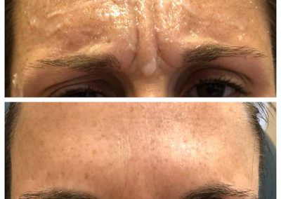 Botulinum toxin for frown lines