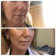 CHEEK AUGMENTATION TREATMENT