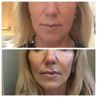 DERMAL FILLERS CAN AUGMENT CHEEKBONES DERMAL FILLERS CAN AUGMENT CHEEKBONES