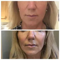 DERMAL FILLERS CAN AUGMENT CHEEKBONES