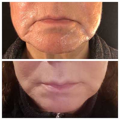 More on Dermal Fillers More on Dermal Fillers