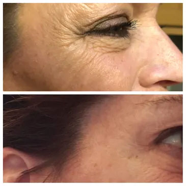 eye wrinkle treatment before-after