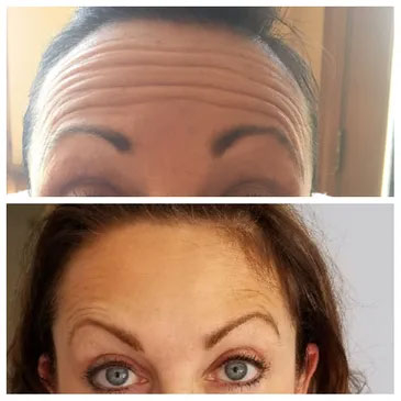 Botulinum toxin for brow and forehead lines