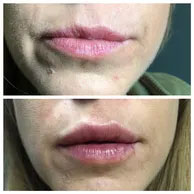 dermal fillers