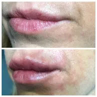 lips dermal fillers before-after