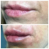 Filling the lips Filling the lips