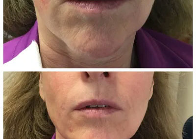 lips dermal fillers before-after