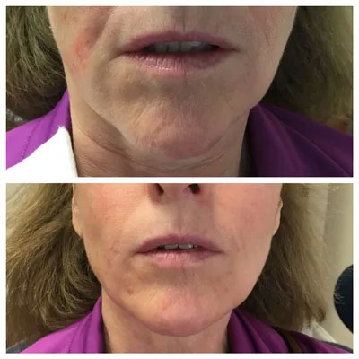 More on Dermal Fillers More on Dermal Fillers