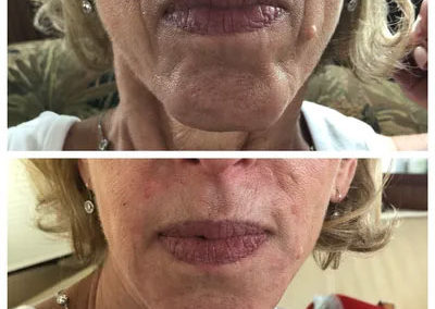 mouth-wrinkle-treatment-before-after