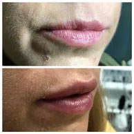 Vertical lip lines ("smoker's lines")