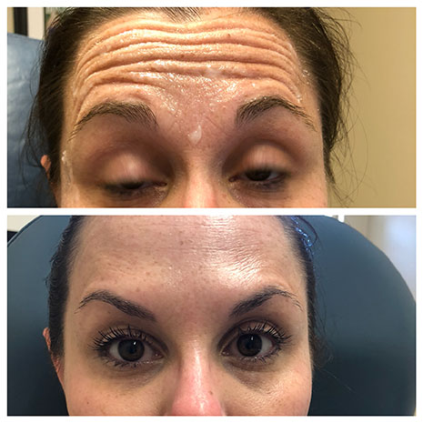 Botox Treatment for Brow and Forhead Wrinkles