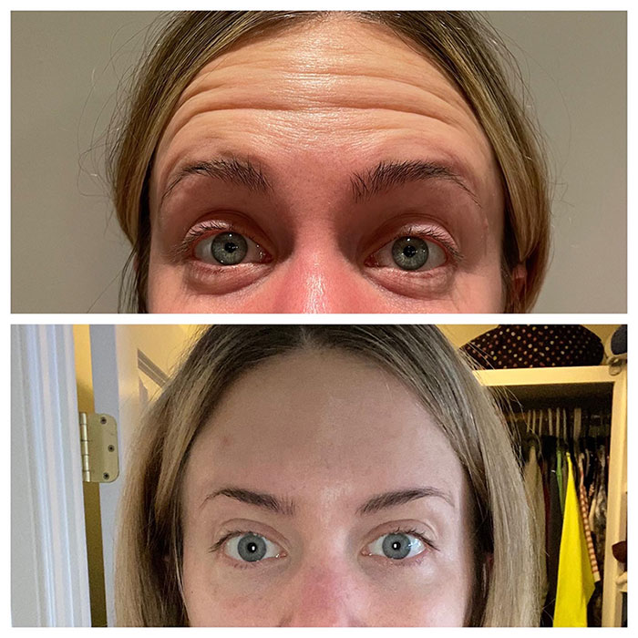 HORIZONTAL RHYTIDS OF THE FOREHEAD HORIZONTAL RHYTIDS OF THE FOREHEAD and forehead lines