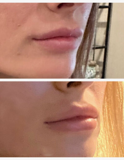lip augmentation with dermal filler.