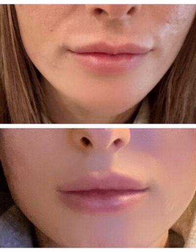 lip augmentation