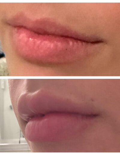 lip augmentation with dermal filler.