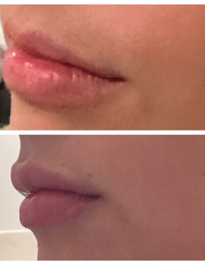 lip augmentation